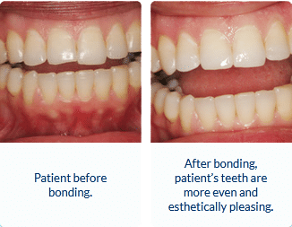 How Dentists Repair a Chipped Tooth, Metro Dental Health