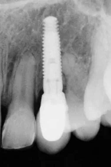 Dental Implant Grand Rapids
