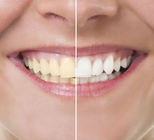 Teeth Whitening Grand Rapids