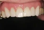 Veneers in Grand Rapids After