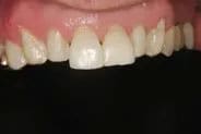 Veneers in Grand Rapids Before